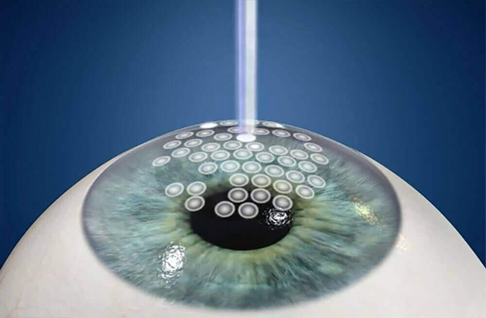 lasik-center-in-boston-ma-laser-vision-correction-boston-laser